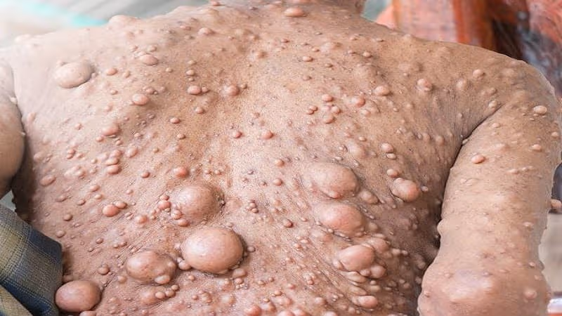U xơ thần kinh xuất hiện trên da