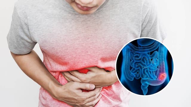 Tìm hiểu về điều trị ung thư đại trực tràng giai đoạn 2