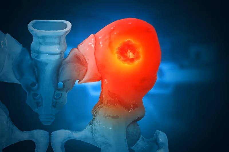 Xương là vị trí di căn phổ biến nhất ở bệnh nhân ung thư vú giai đoạn cuối