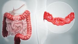 Viêm đại tràng do C. difficile có dấu hiệu gì? Chẩn đoán và điều trị ra sao?