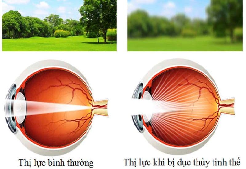 đục thủy tinh thể
