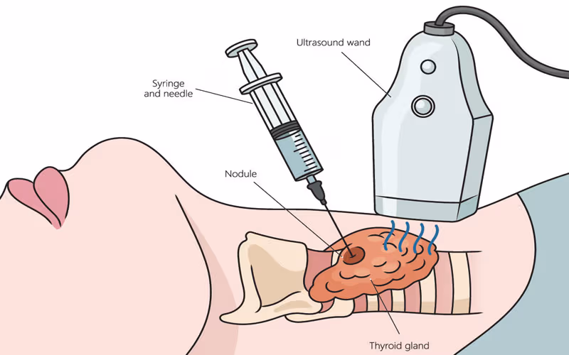 Chọc hút tế bào bằng kim nhỏ giúp chẩn đoán chính xác bản chất khối u tuyến giáp