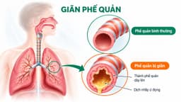 Giãn phế quản: Nguyên nhân, cách chẩn đoán và điều trị