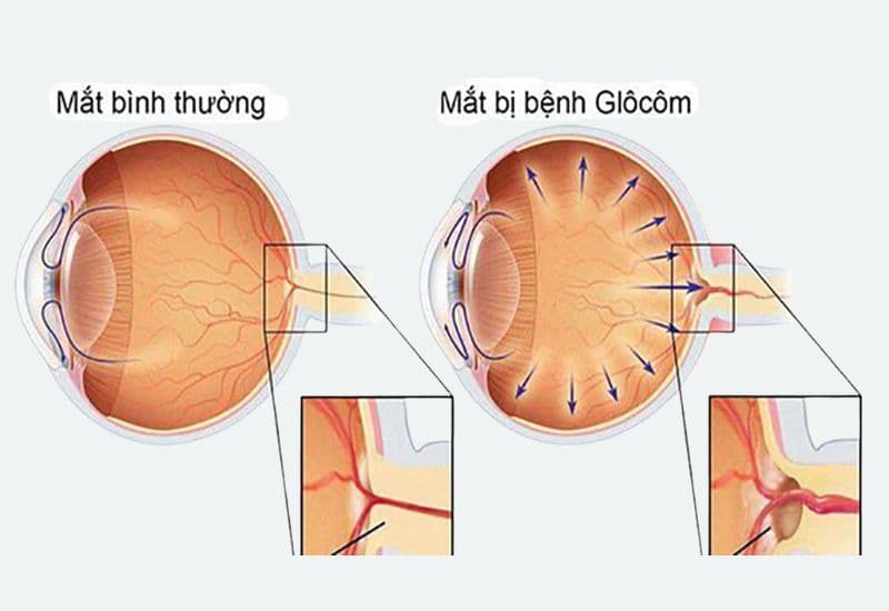 glôcôm góc mở