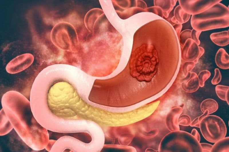 Hạ vị dạ dày là cách gọi có thể được dùng để mô tả cảm giác đau hoặc khó chịu ở vùng bụng trên, gần khu vực dạ dày