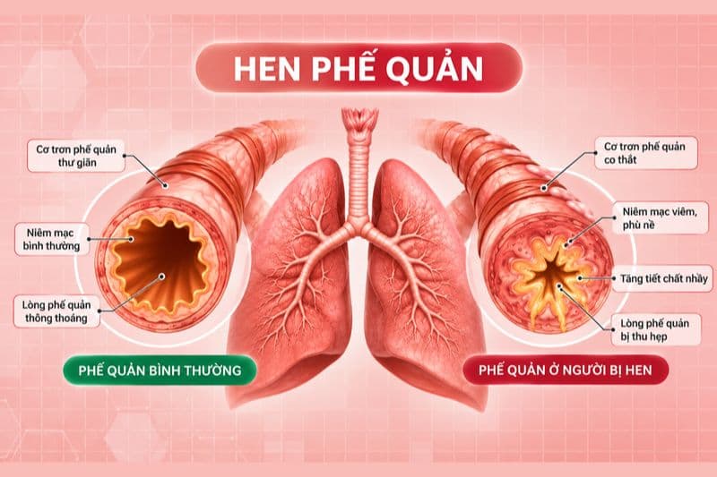 Hen suyễn là bệnh hô hấp mạn tính, đường thở bị co thắt khiến luồng không khí lưu thông khó khăn.