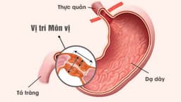 Hẹp môn vị: Dấu hiệu nhận biết, nguyên nhân và điều trị như thế nào?