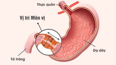 Hẹp môn vị: Dấu hiệu nhận biết, nguyên nhân và điều trị như thế nào?
