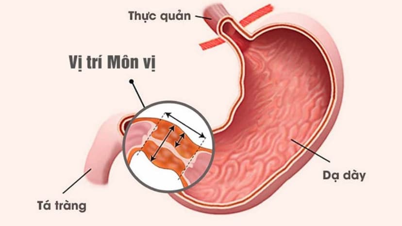 Hẹp môn vị: Dấu hiệu nhận biết, nguyên nhân và điều trị như thế nào?