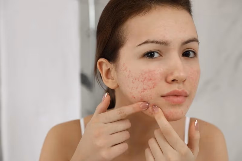 Rối loạn kinh nguyệt, nổi mụn kéo dài, rậm lông là những biểu hiện phụ nữ cần chú ý.