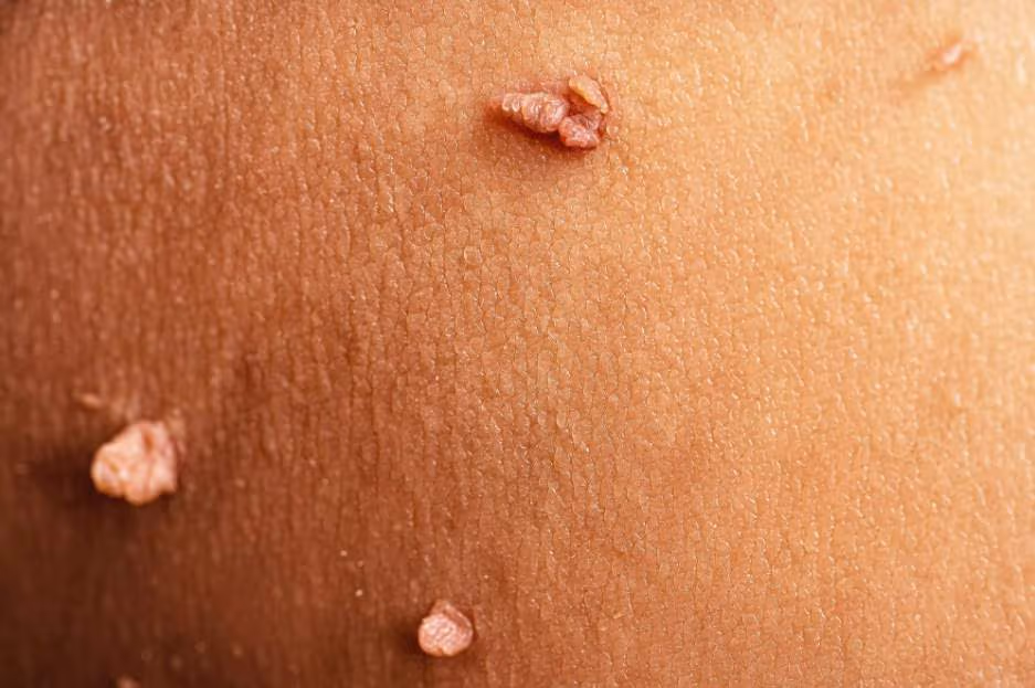 Thông tin tổng quan về mụn cóc hậu môn