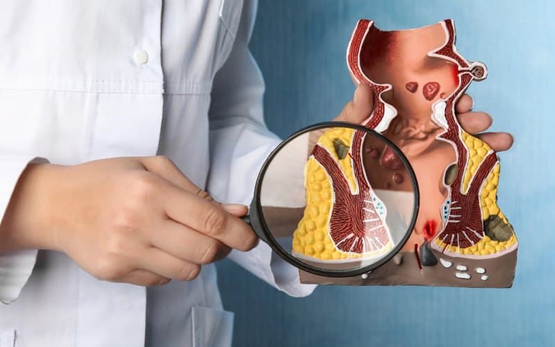 Táo bón là một trong những nguyên nhân chính gây nứt kẽ hậu môn