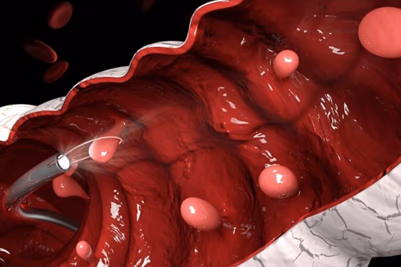 Polyp tá tràng là hiện tượng xuất hiện các khối nhú hoặc tổn thương nhô lên bất thường trên bề mặt niêm mạc của đoạn ruột này