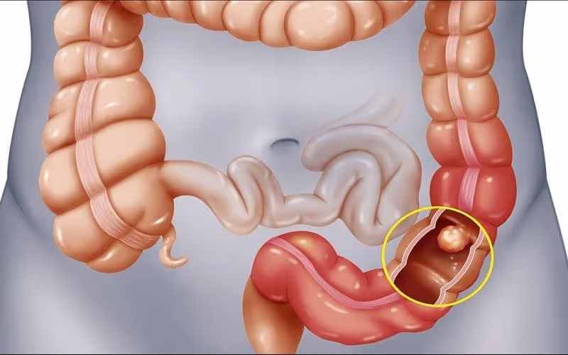 U đại tràng có thể là lành tính hoặc ác tính