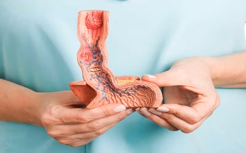 U dưới niêm mạc dạ dày nằm sâu hơn và được che phủ bởi lớp niêm mạc