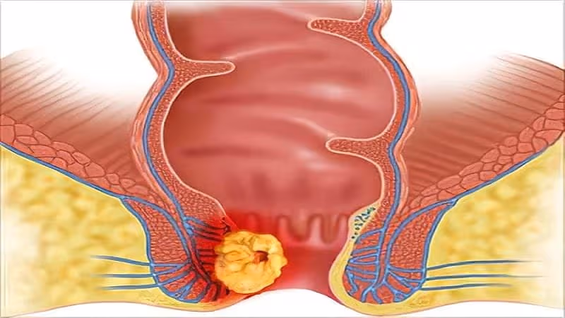 U hậu môn có thể là lành tính hoặc ác tính