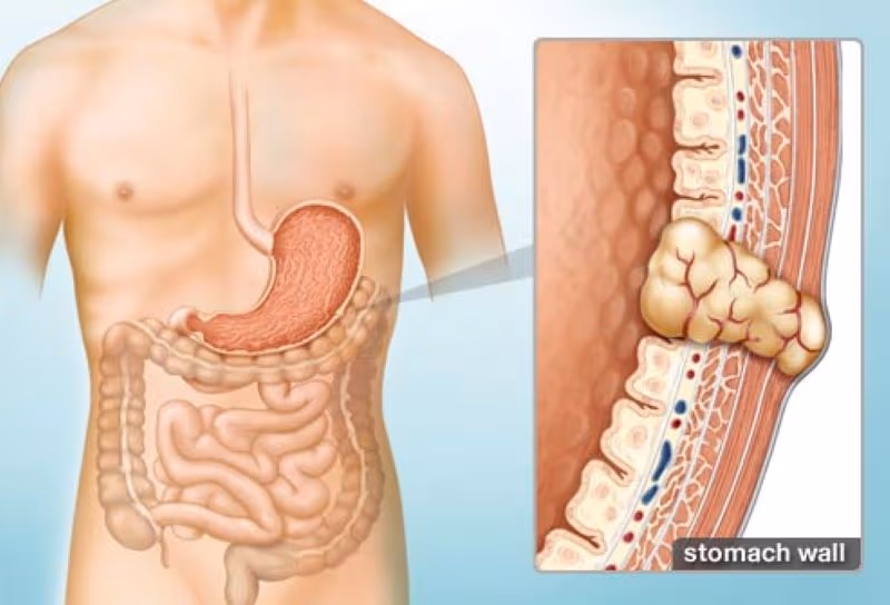 Phác đồ điều trị u mô đệm đường tiêu hóa (GIST) được xây dựng dựa trên kích thước, vị trí khối u và nguy cơ tái phát