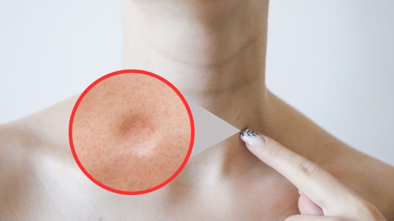 Phần lớn u mỡ là u lành tính, không phải ung thư và thường không cần điều trị nếu không gây khó chịu