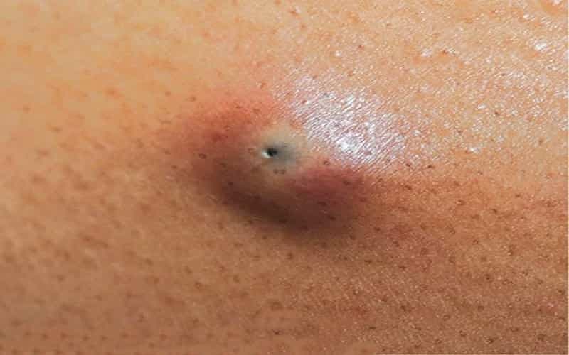 Hình ảnh u nang biểu bì dưới da