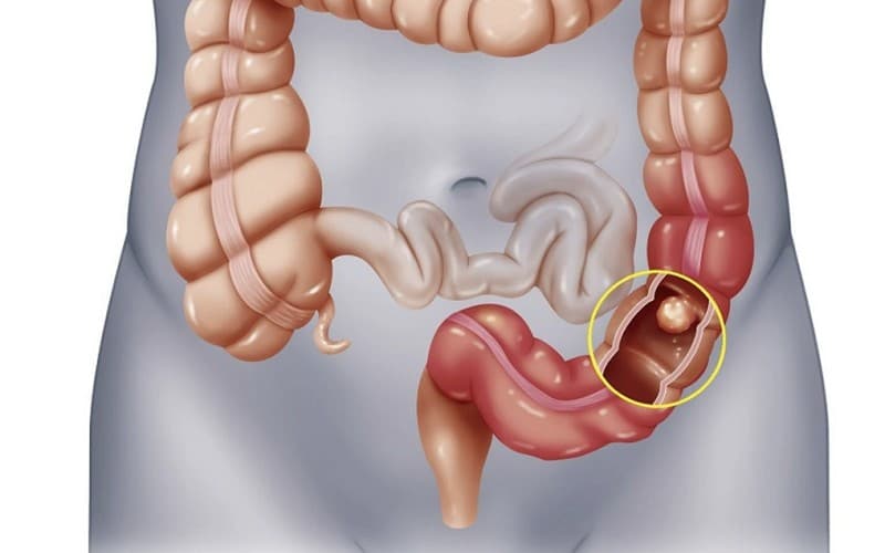 Giải đáp thắc mắc u trực tràng thấp là gì