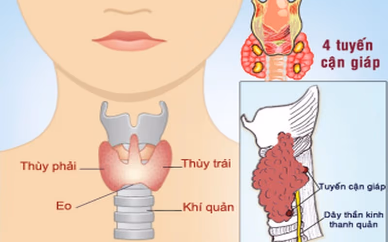 Khái niệm u tuyến cận giáp và nguyên nhân gây ra bệnh
