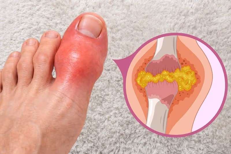 Các hạt tinh thể đọng lại xung quanh khớp xương, gây ra tình trạng sưng tấy và đau dữ dội