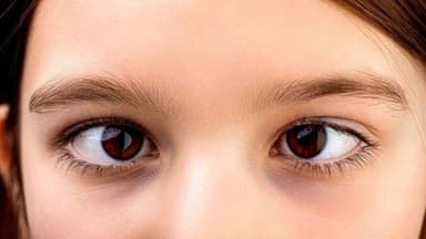 Lác mắt là gì? Nguyên nhân, chẩn đoán và điều trị lác mắt hiệu quả