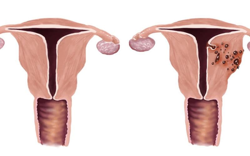 lạc tuyến cơ tử cung