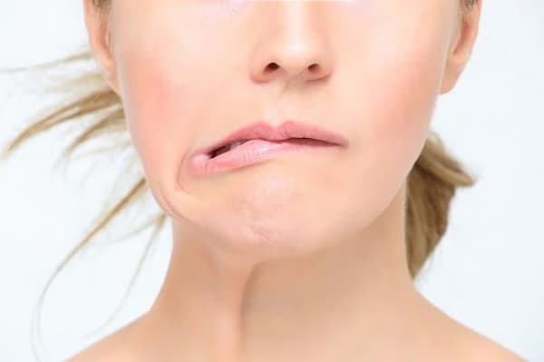 Bị liệt dây thần kinh số 7 ảnh hưởng đến khả năng vận động và vùng mặt