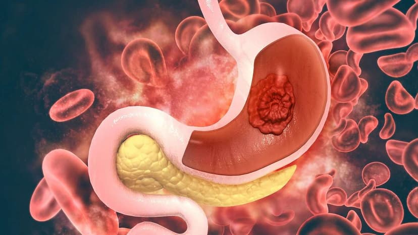 Vì sao bị loét thực quản? Dấu hiệu nhận biết và cách điều trị