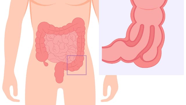Lồng ruột người lớn có nguy hiểm không?