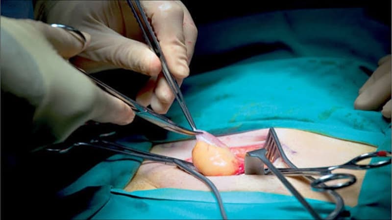 Phẫu thuật thoát vị rốn giúp đưa phần tạng thoát vị trở về ổ bụng