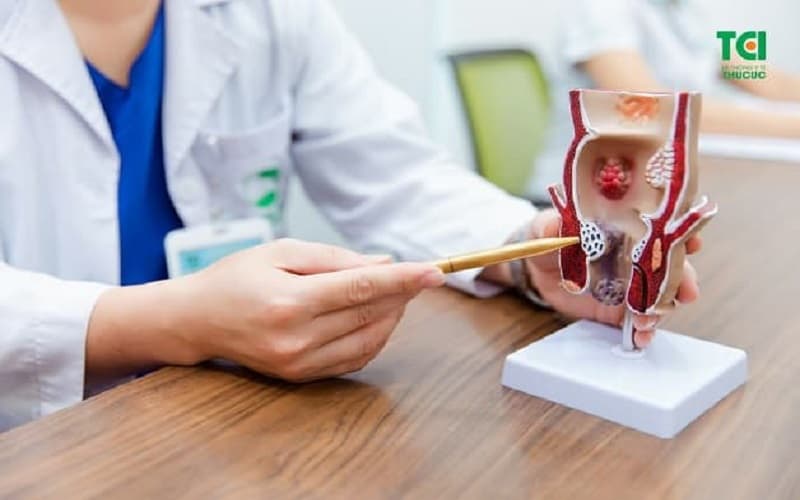 Lựa chọn cách chữa trĩ nội phụ thuộc vào mức độ nghiêm trọng và cấp độ tiến triển của bệnh