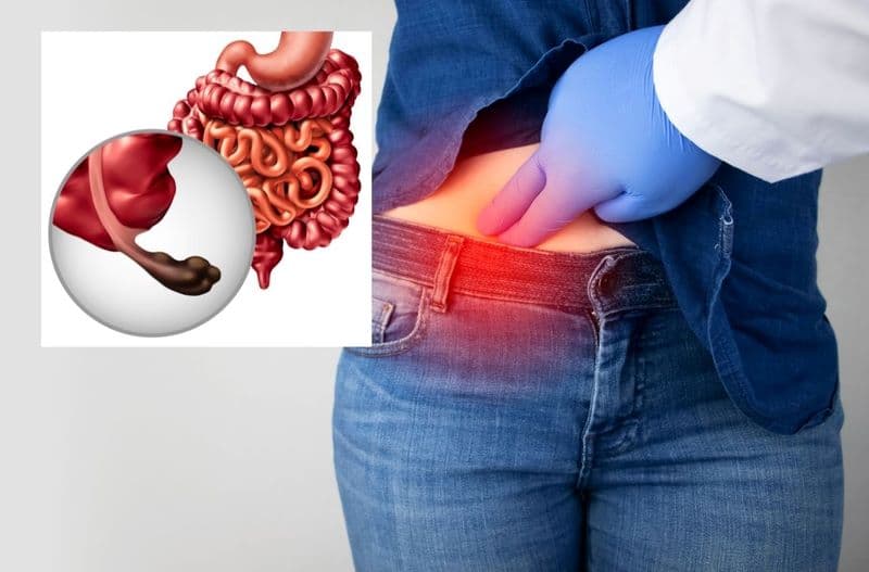 Áp xe ruột thừa là một ổ chứa mủ hình thành ở khu vực xung quanh ruột thừa
