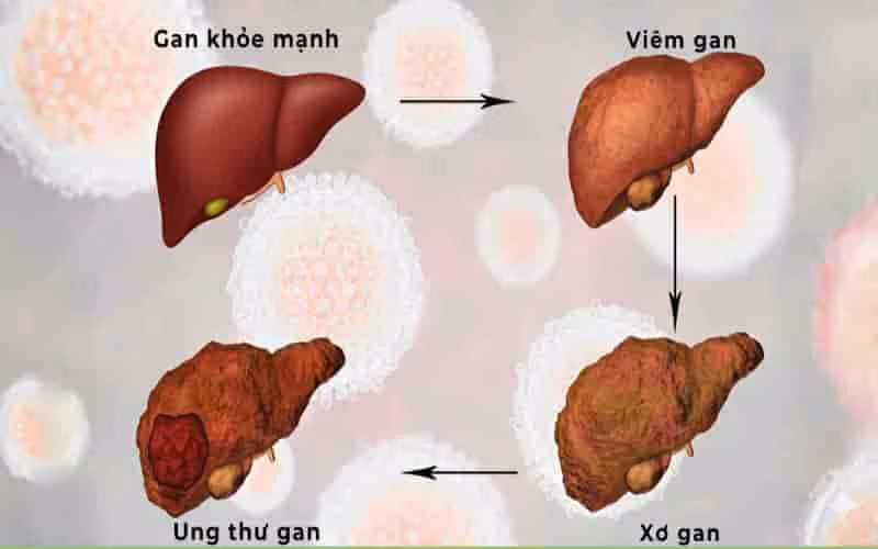 Xơ gan có thể cản trở dòng máu qua gan, làm tăng áp lực tĩnh mạch cửa