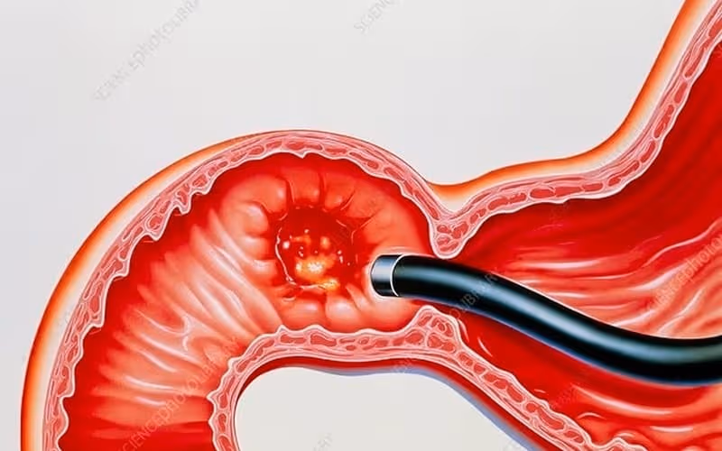 Loét tá tràng ở đoạn đầu ruột non
