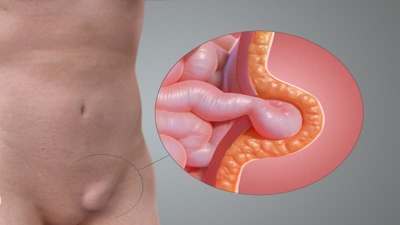 Nguyên nhân thoát vị bẹn chủ yếu là do thành bụng vùng bẹn bị suy yếu