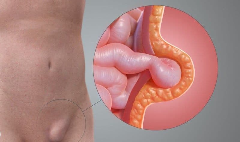 Nguyên nhân thoát vị đường trắng chủ yếu liên quan đến sự suy yếu hoặc khiếm khuyết của mô liên kết ở đường trắng