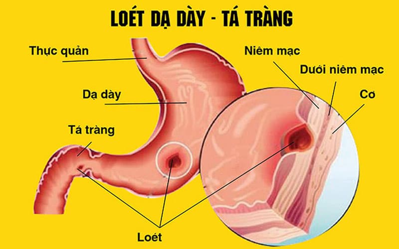 Viêm loét dạ dày là nguyên hàng đầu gây thủng dạ dày