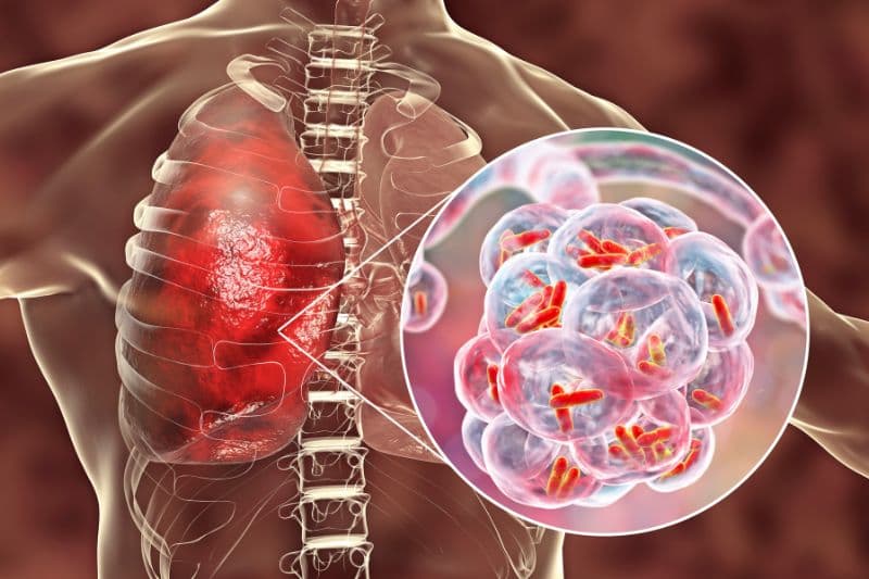 Nhiễm khuẩn tại nhu mô phổi có thể gây viêm lan đến màng phổi, dẫn đến tích tụ dịch.