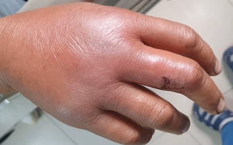 Viêm mô tế bào thường gây sưng đau và có thể kèm sốt