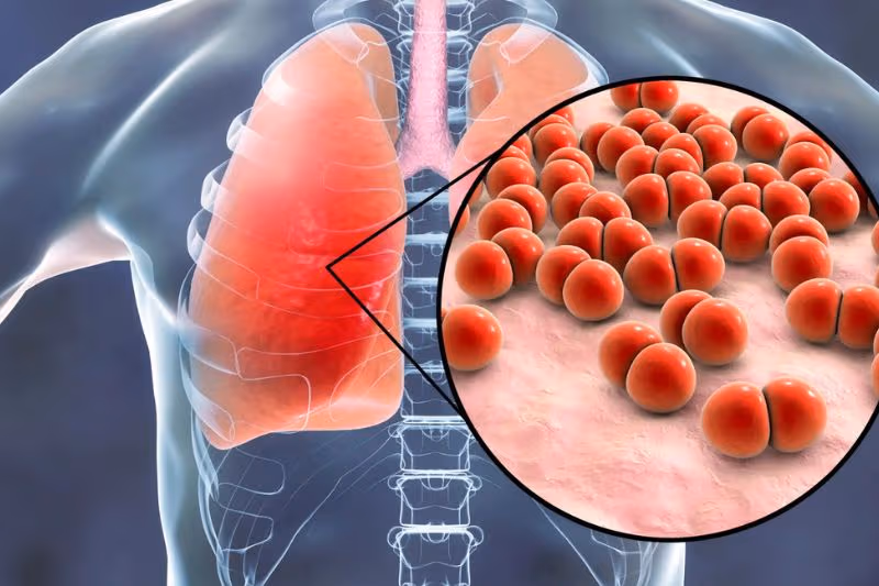 Vi khuẩn, virus và nấm là những tác nhân chính gây viêm phổi.