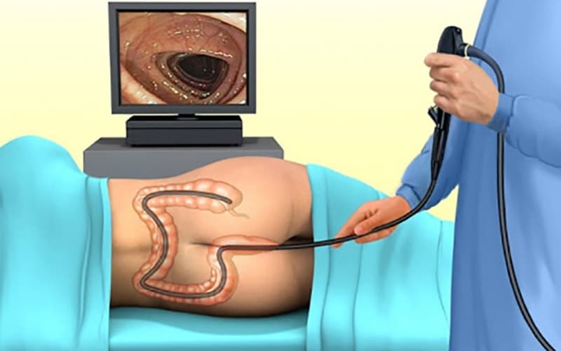 Viêm trực tràng có thể được chẩn đoán qua nội soi ống mềm