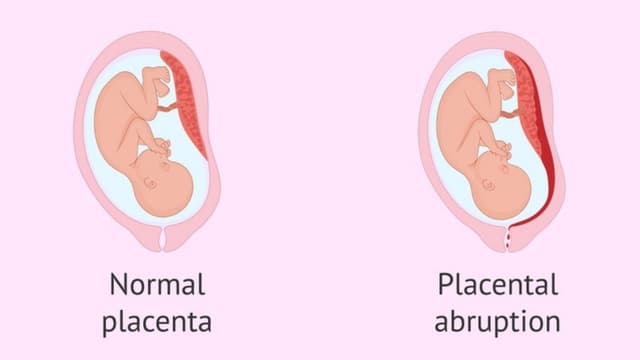 Nhau bong non là gì, dấu hiệu nhận biết và cách xử trí
