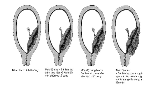 Biến chứng nhau cài răng lược nguy hiểm như thế nào?