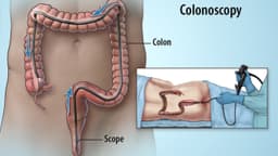 Nội soi đại tràng có nguy hiểm không? Rủi ro và biến chứng cần biết