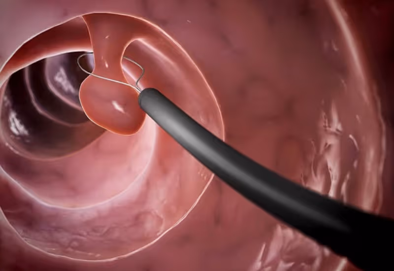 Có thể phát hiện và cắt polyp trong khi thực hiện nội soi đại tràng