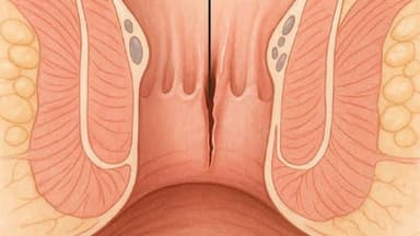 Nứt kẽ hậu môn là gì và có thể tự khỏi mà không cần phẫu thuật không?