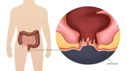 Nứt kẽ hậu môn do táo bón có tự khỏi được không? Cách điều trị thế nào?