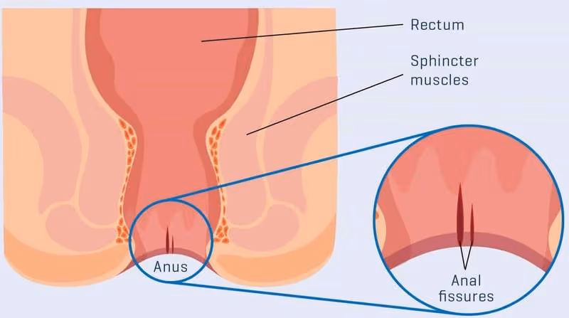 Nứt kẽ hậu môn mạn là tình trạng vết rách ở niêm mạc ống hậu môn kéo dài, thường trên 6-8 tuần và khó tự lành